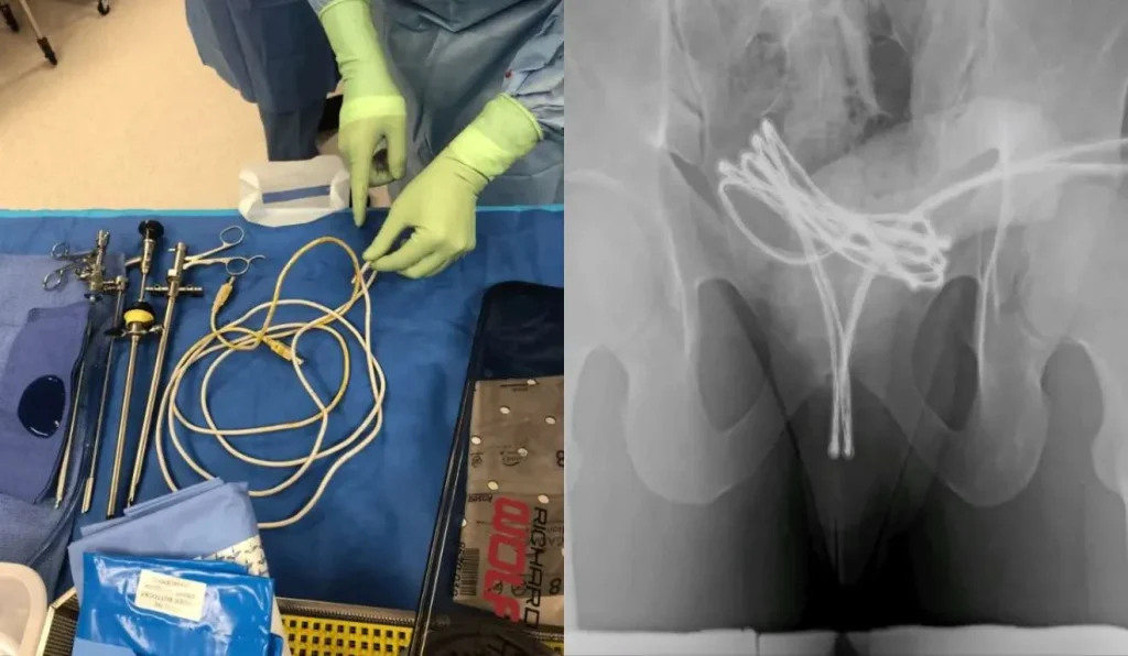 Jovem enfia cabo USB em órgão genital e passa por cirurgia para retirá-lo